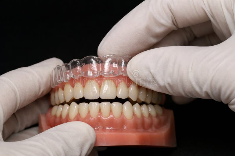 Clear aligners (invisible braces)